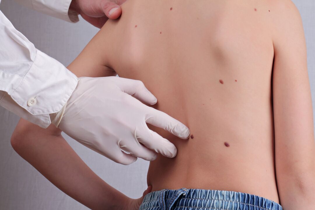 Dermatolog przeprowadza badanie kliniczne pacjenta z brodawczakami na ciele