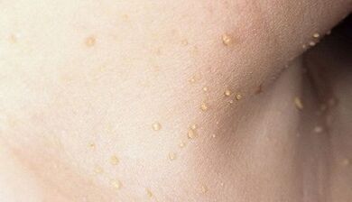 ryzyko rozwoju brodawczaka na szyi