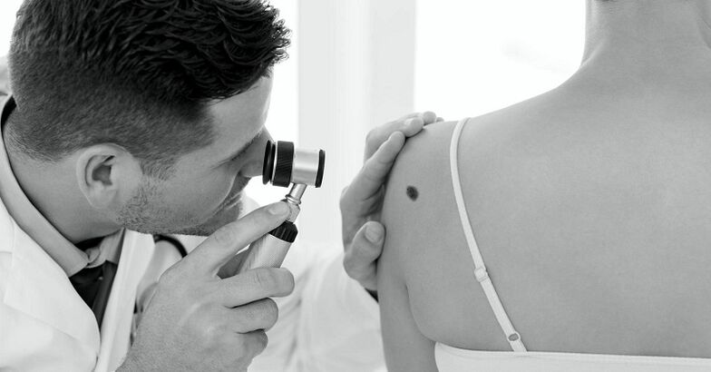 specjalista diagnozuje rodzaj brodawki