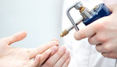 KRYODSTRUKRYCJA jako metoda leczenia brodawek